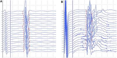 Clinical and Physiological Significance of F-Wave in Spinocerebellar Ataxia Type 3